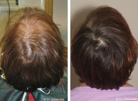 PRP-hair-loss-treatment-before-and-after-images-The-Belgravia-Centre-Hair-Loss-Blog