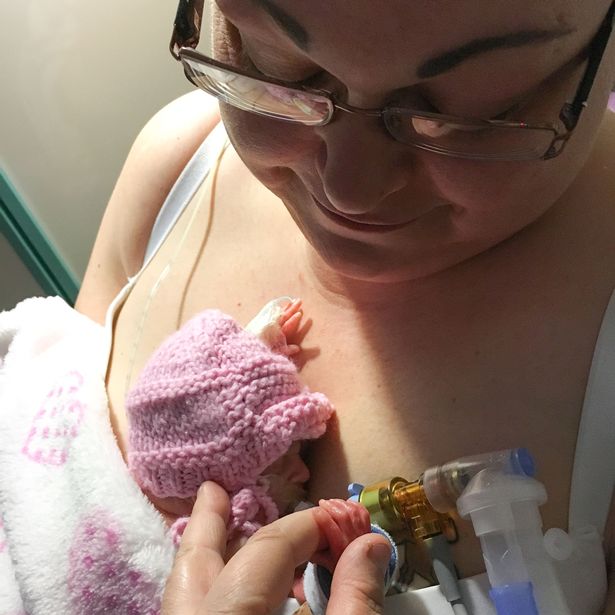 PAY-PREMATURE-MIRACLE-BABY-BORN-WITH-FEET-THE-SIZE-OF-PENNY-JUST-TWO-DAYS-AFTER-24-WEEK-ABORTION-LIMIT (1)